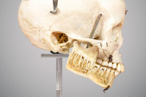 Close detalhado do lado esquerdo do crânio, destacando a mandíbula cortada verticalmente para mostrar a estrutura interna dos dentes e raízes. Pequenas molas e parafusos metálicos conectam partes móveis do osso, permitindo a abertura da mandíbula para estudo anatômico.